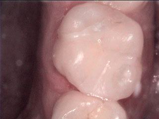 White Fillings-After