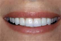 Porcelain Veneers