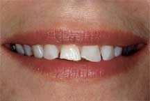 Porcelain Veneers