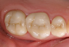 After Cosmetic Dentistry