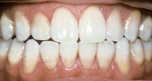 Tooth Whitening -After