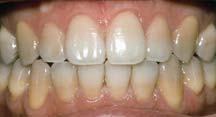 Tooth Whitening Before